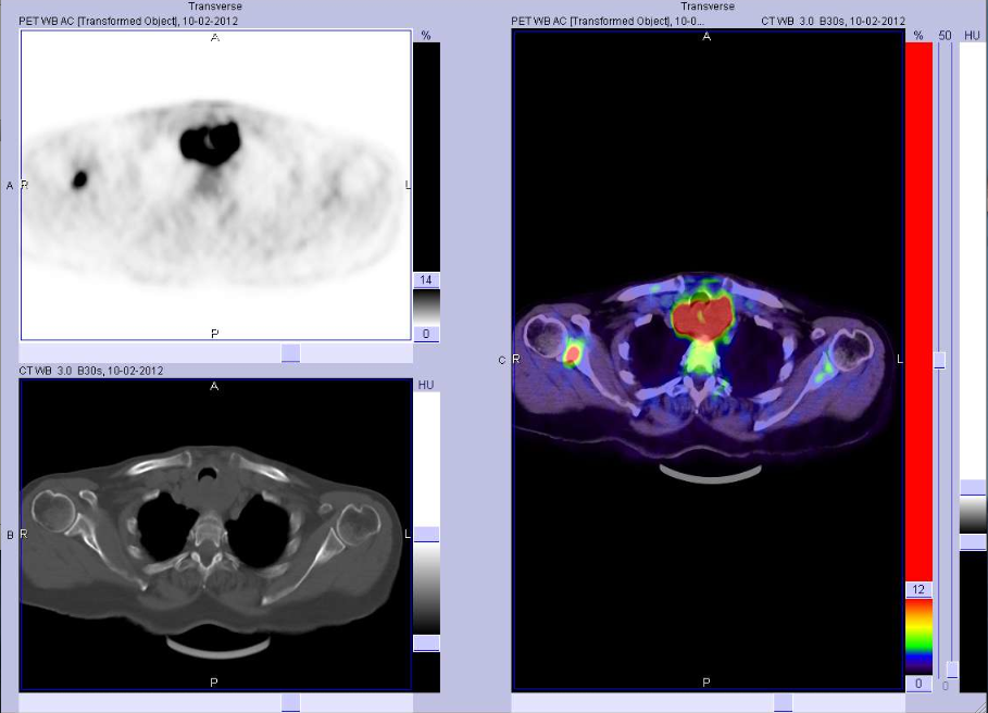 18FDG-PET-TC: Carcinoma anaplastico della tiroide, recidiva locale con invasione tracheale dopo debulking chirurgico