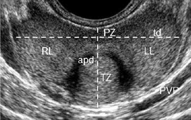 prostata disomogenea di asse ll e