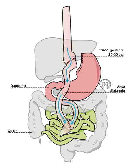 Dating qualcuno che aveva bypass gastrico