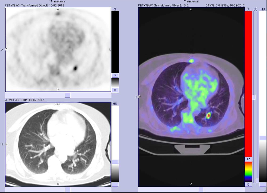 18FDG-PET-TC: metastasi polmonare da Carcinoma anaplastico della tiroide