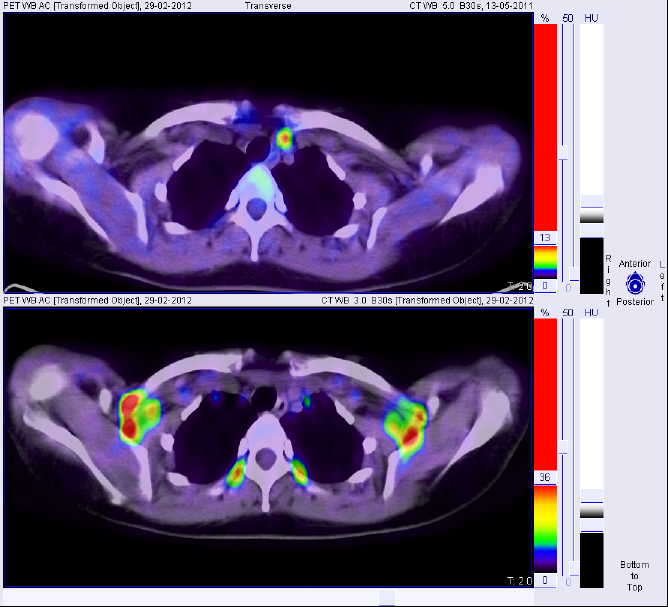 8FDG-PET-TC: Carcinoma papillare della tiroide scarsamente differenziato, asportazione di metastasi linfonodale retrosternale mediante chirurgia radioguidata