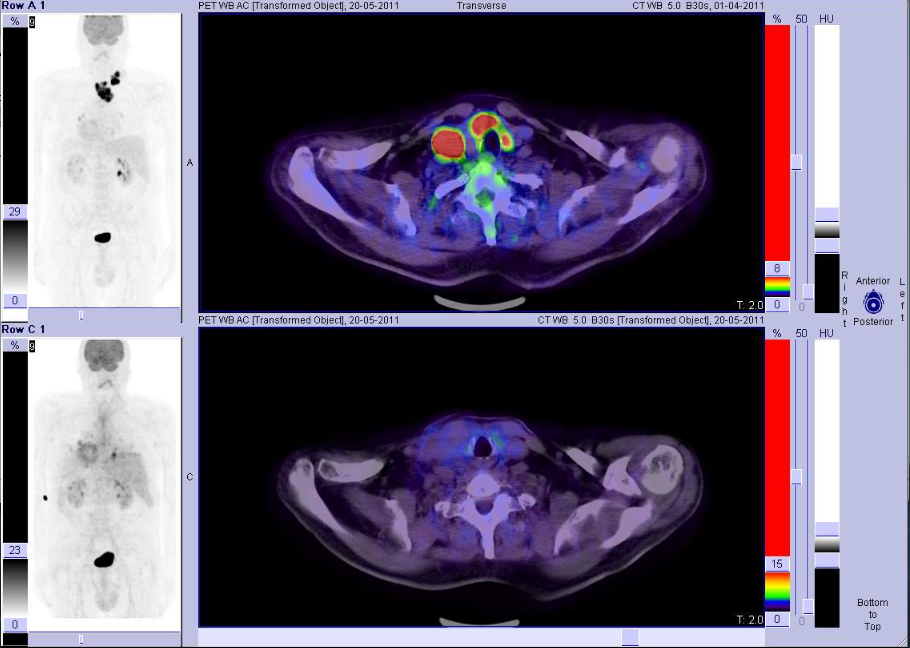 18FDG-PET-TC: Carcinoma papillare della tiroide scarsamente differenziato, asportazione di metastasi linfonodale al collo ed al mediastino mediante chirurgia radioguidata