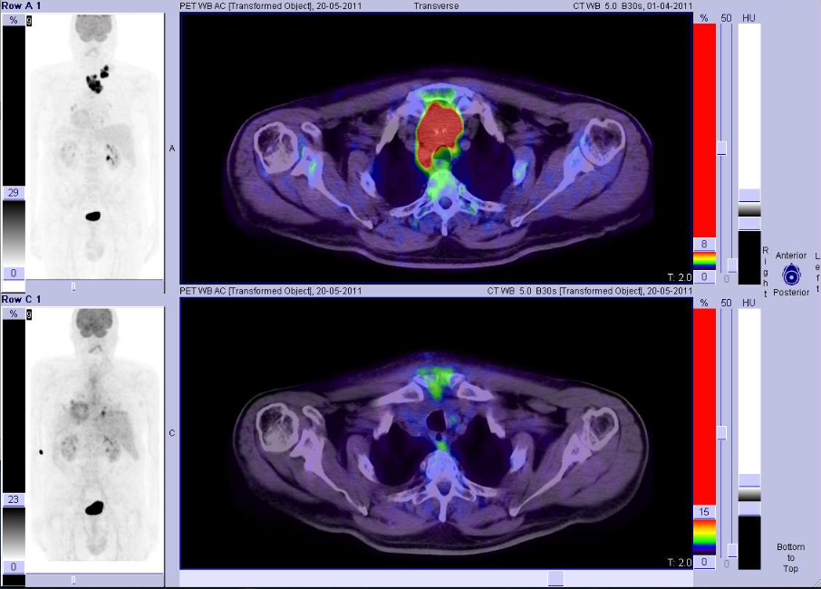 18FDG-PET-TC: Carcinoma papillare della tiroide scarsamente differenziato, asportazione di metastasi linfonodali mediastiniche mediante chirurgia radioguidata